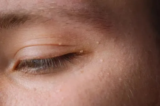 Không để mụn thịt “lấn chiếm” làn da – Bạn cần biết những điều này! Không để mụn thịt “lấn chiếm” làn da – Bạn cần biết những điều này!