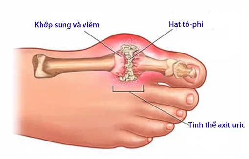 Điều trị bệnh gout theo Y học cổ truyền Điều trị bệnh gout theo Y học cổ truyền
